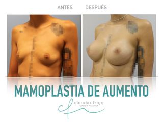 Aumento de pecho - Dra. Claudia Frigo