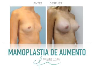 Aumento de pecho - Dra. Claudia Frigo