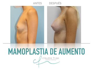 Aumento de pecho - Dra. Claudia Frigo