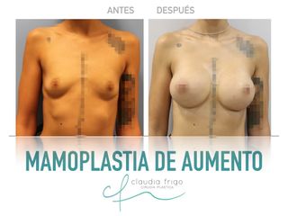 Aumento de pecho - Dra. Claudia Frigo