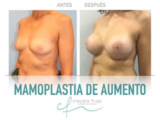 Aumento de pecho - Dra. Claudia Frigo
