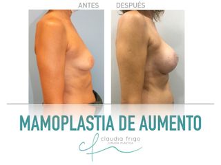 Aumento de pecho - Dra. Claudia Frigo
