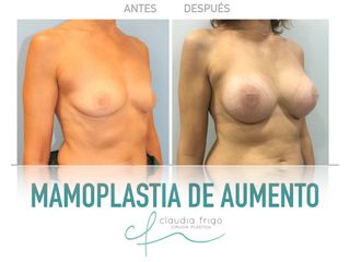 Aumento de pecho - Dra. Claudia Frigo
