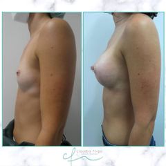Aumento de pecho - Dra. Claudia Frigo