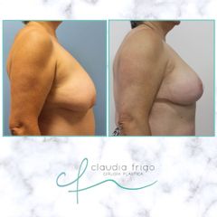 Mastopexia - Dra. Claudia Frigo