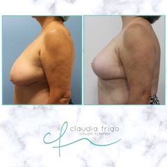 Mastopexia - Dra. Claudia Frigo