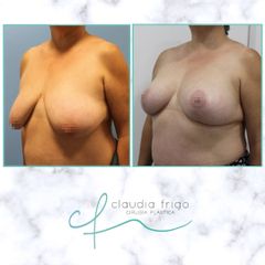 Mastopexia - Dra. Claudia Frigo