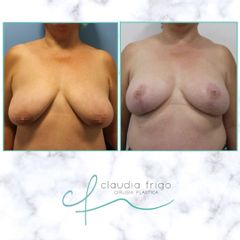 Mastopexia - Dra. Claudia Frigo