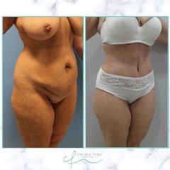 Abdominoplastia - Dra. Claudia Frigo