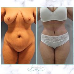 Abdominoplastia - Dra. Claudia Frigo