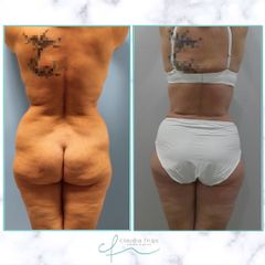 Abdominoplastia - Dra. Claudia Frigo