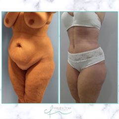 Abdominoplastia - Dra. Claudia Frigo