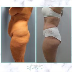 Abdominoplastia - Dra. Claudia Frigo