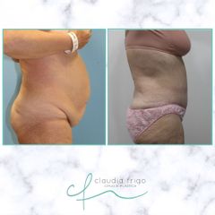 Abdominoplastia - Dra. Claudia Frigo