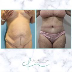 Abdominoplastia - Dra. Claudia Frigo