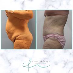 Abdominoplastia - Dra. Claudia Frigo