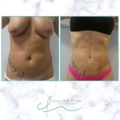 Liposucción - Dra. Claudia Frigo