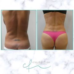 Liposucción - Dra. Claudia Frigo