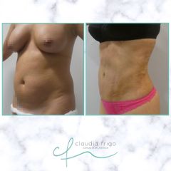 Liposucción - Dra. Claudia Frigo