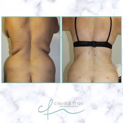 Liposucción - Dra. Claudia Frigo