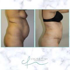 Abdominoplastia - Dra. Claudia Frigo