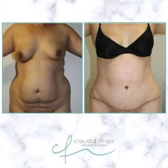 Abdominoplastia - Dra. Claudia Frigo