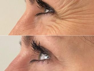 Eliminación arrugas antes y después - 876742