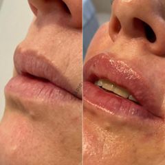 Sapphira Privé Aravaca - Aumento de labios