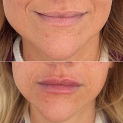 Sapphira Privé Aravaca - Aumento de labios