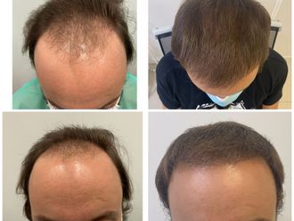 Trasplantes capilares - 797983