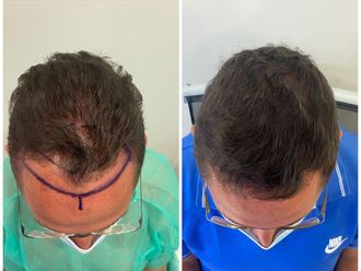 Trasplantes capilares - 798904