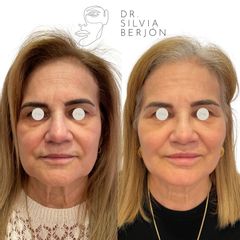 Rejuvenecimiento Facial - Dra. Silvia Berjón Argente