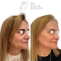 Rejuvenecimiento Facial - Dra. Silvia Berjón Argente