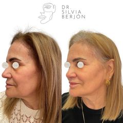 Rejuvenecimiento Facial - Dra. Silvia Berjón Argente