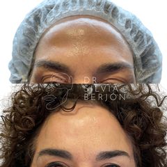 Rellenos Faciales - Dra. Silvia Berjón Argente