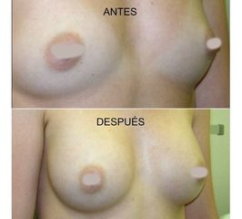 Antes y después Aumento de pecho