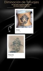 Eliminación de tatuajes - Sapphira Privé Córdoba Vial