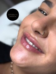 Aumento de labios - Sapphira Privé Córdoba Vial