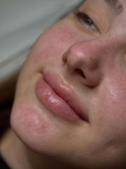 Aumento de labios - Sapphira Privé Córdoba Vial