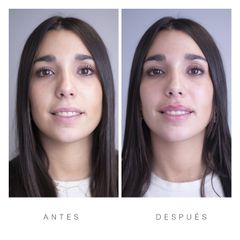 Antes y Después Aumento de Labios
