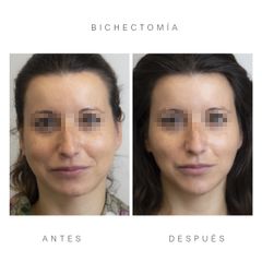 Antes y después Bichectomia