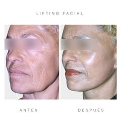 Antes y después lifting facial