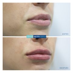 Aumento de labios - Clínica Opción Médica