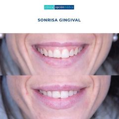 Sonrisa gingival - Clínica Opción Médica