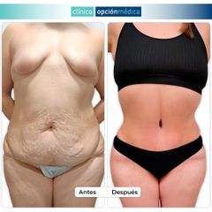 Abdominoplastia - Clínica Opción Médica