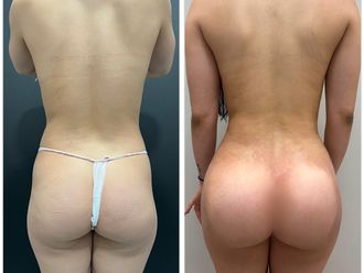 Lipofilling antes y después - 876675