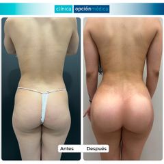 Lipotransferencia a glúteos - Clínica Opción Médica