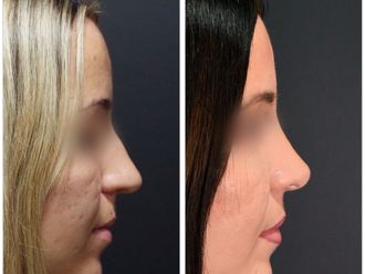 Rinoplastia antes y después - 876676