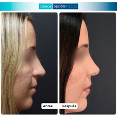 Rinoplastia - Clínica Opción Médica