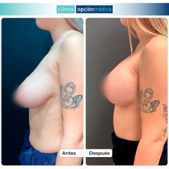 Mastopexia - Clínica Opción Médica